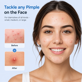 Pellure Acne Patch Variety Pack — 443 Count, 5 Sizes